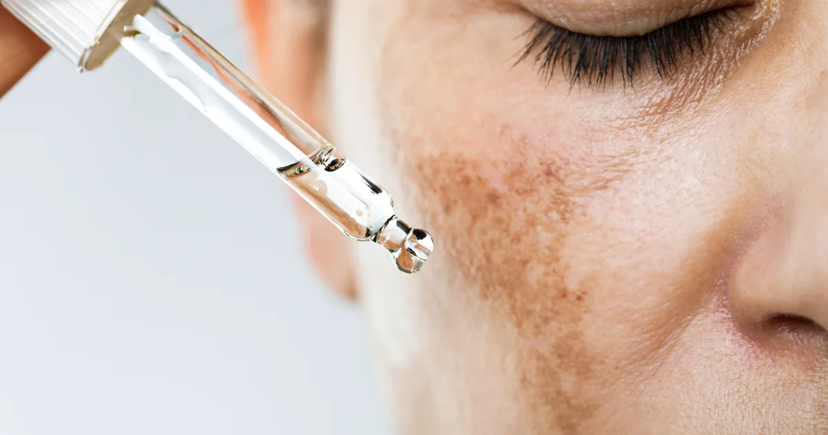 Heres-What-Derms-Recommend-To-Reduce-The-Appearance-Of-Melasma