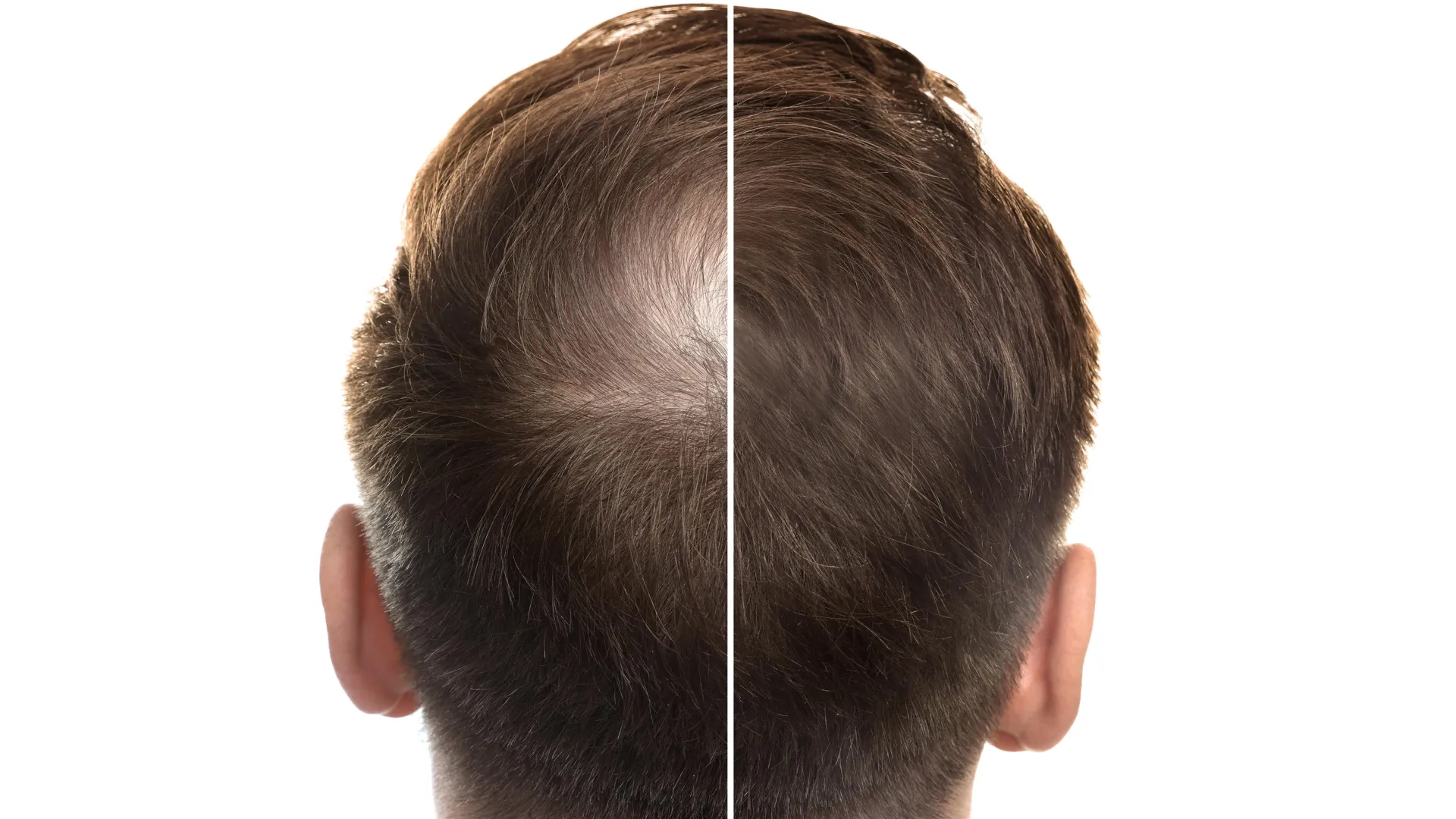 A-Sweet-Fix-For-Baldness-Stevia-Compound-Boosts-Hair-Growth