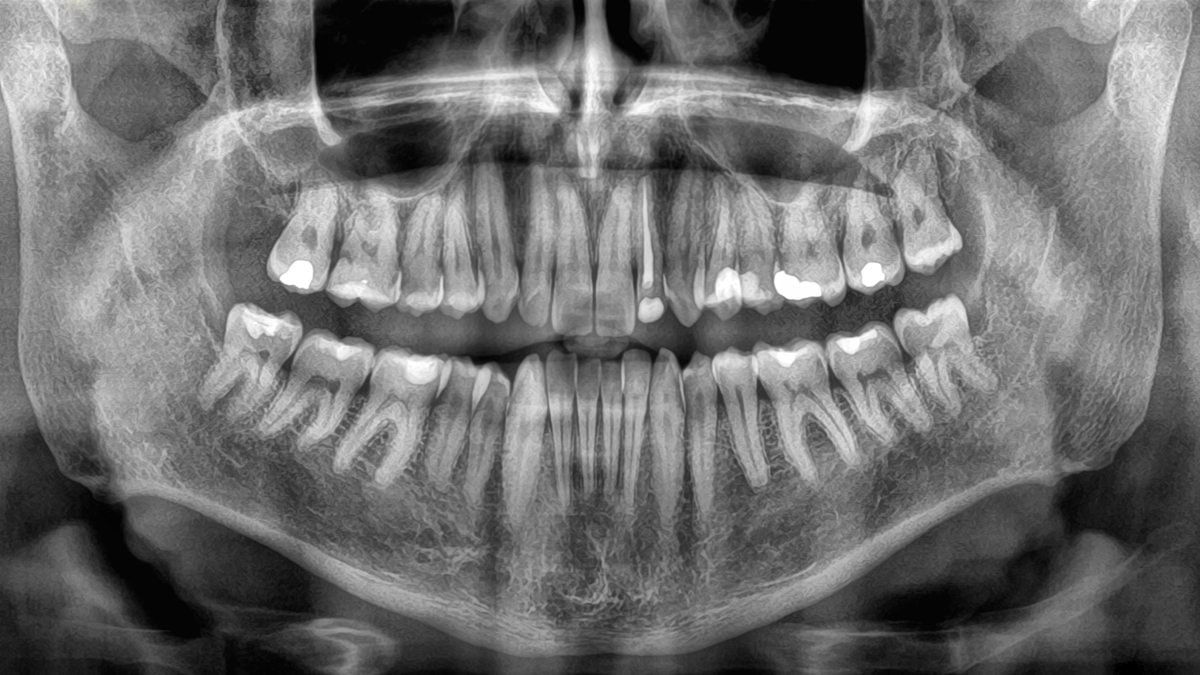 Losing-Your-Teeth-Could-Be-A-Deadly-Warning-Study-Finds