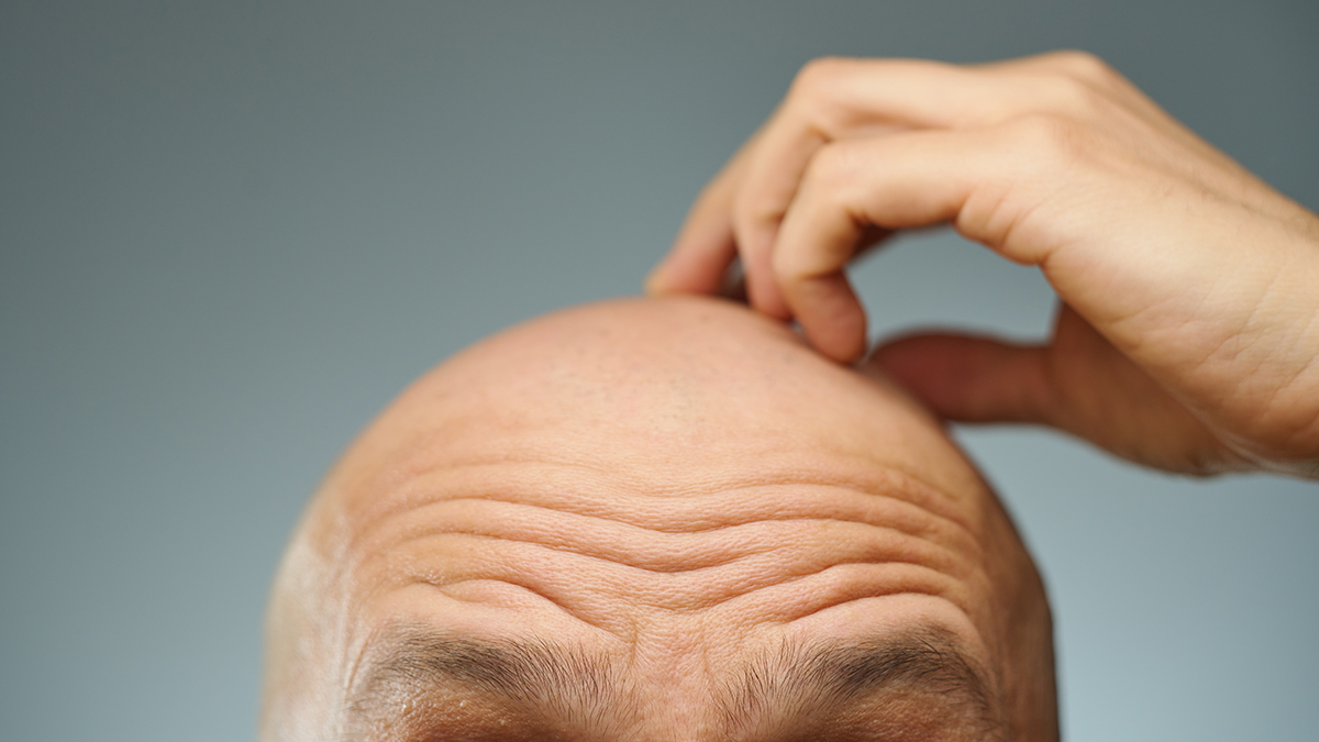 Baldness-Breakthrough-Fat-Cells-Could-Be-The-Secret-To-Rapid-Hair-Regrowth