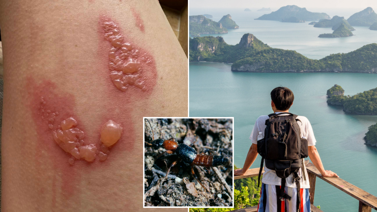Bali-Tourists-Warned-About-Painful-Threat-After-Aussie-Woman-Left-With-Shocking-Rashes